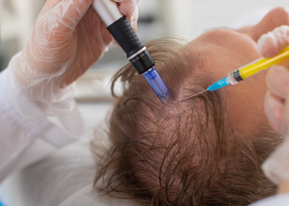 Haarausfall falsch behandelt