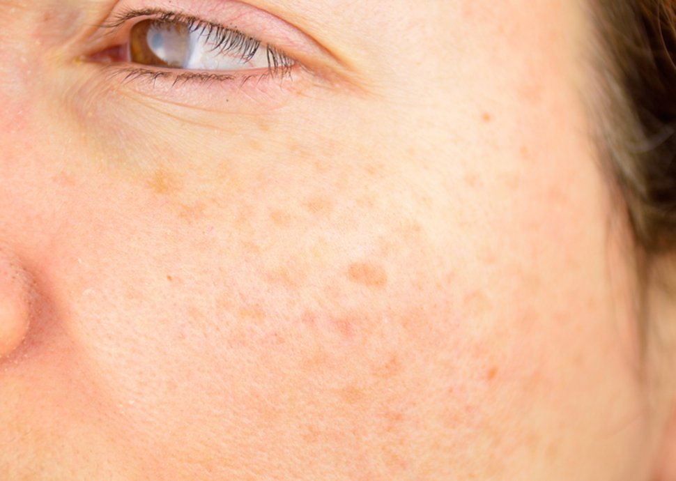 Pigmentflecken: was sie wirklich auslöst