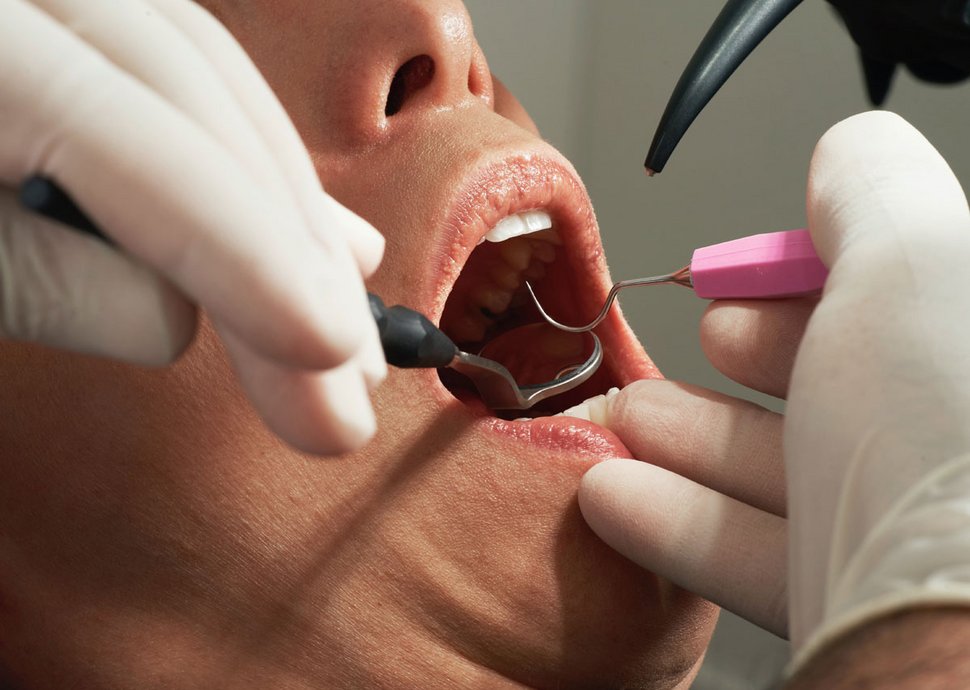 Mit einer Zahnzusatzversicherung lässt sich vor allem Zahnersatz deutlich besser und günstger gestalten.