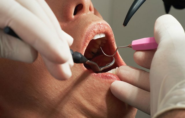Mit einer Zahnzusatzversicherung lässt sich vor allem Zahnersatz deutlich besser und günstger gestalten.