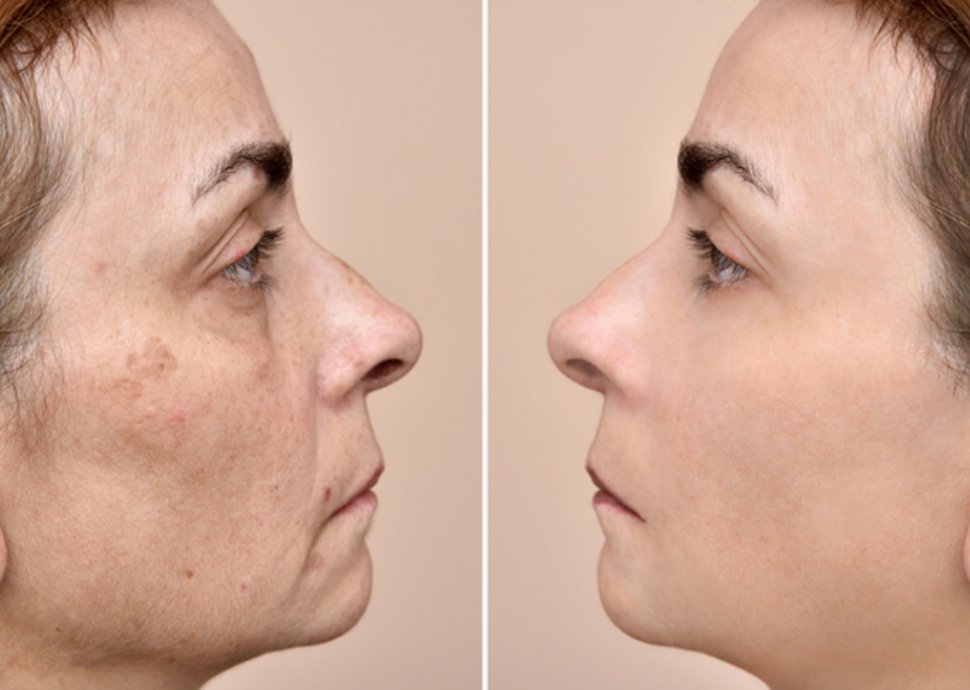 Pigmentflecken loswerden: effektive Methoden Pigmentflecken loswerden: effektive Methoden