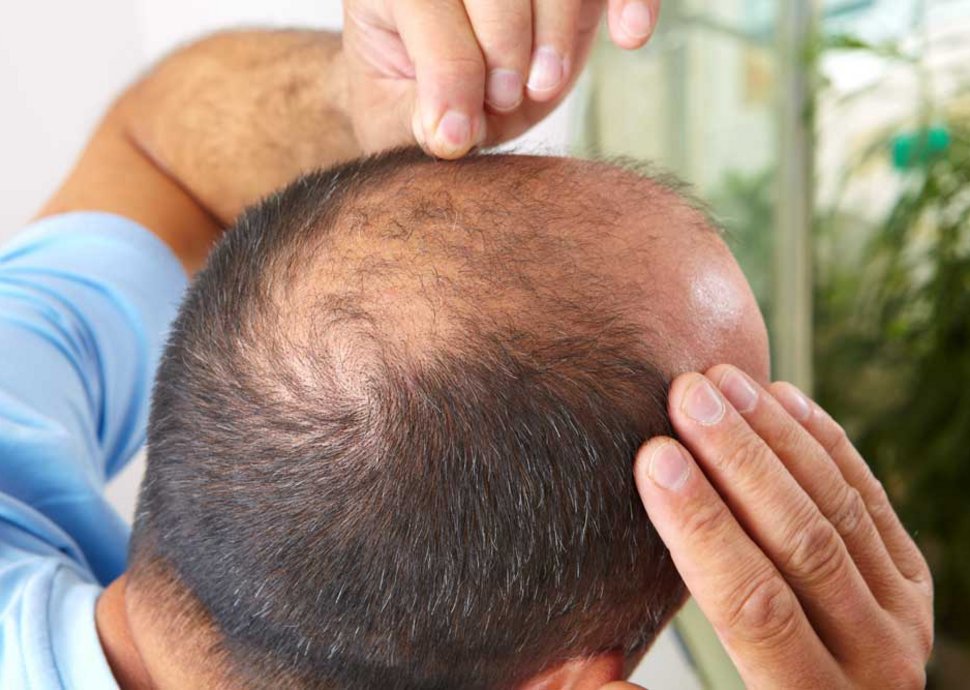 Männer leiden bereits ab dem 25. Lebensjahr an Haarausfall.