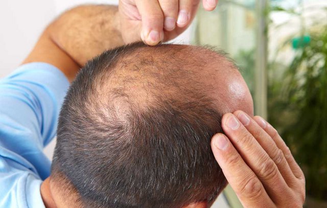 Männer leiden bereits ab dem 25. Lebensjahr an Haarausfall.