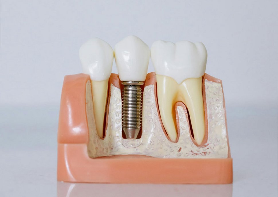 Zahnersatz sollte sich möglichst natürlich anfühlen.