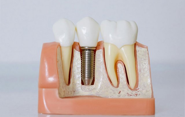 Zahnersatz sollte sich möglichst natürlich anfühlen.