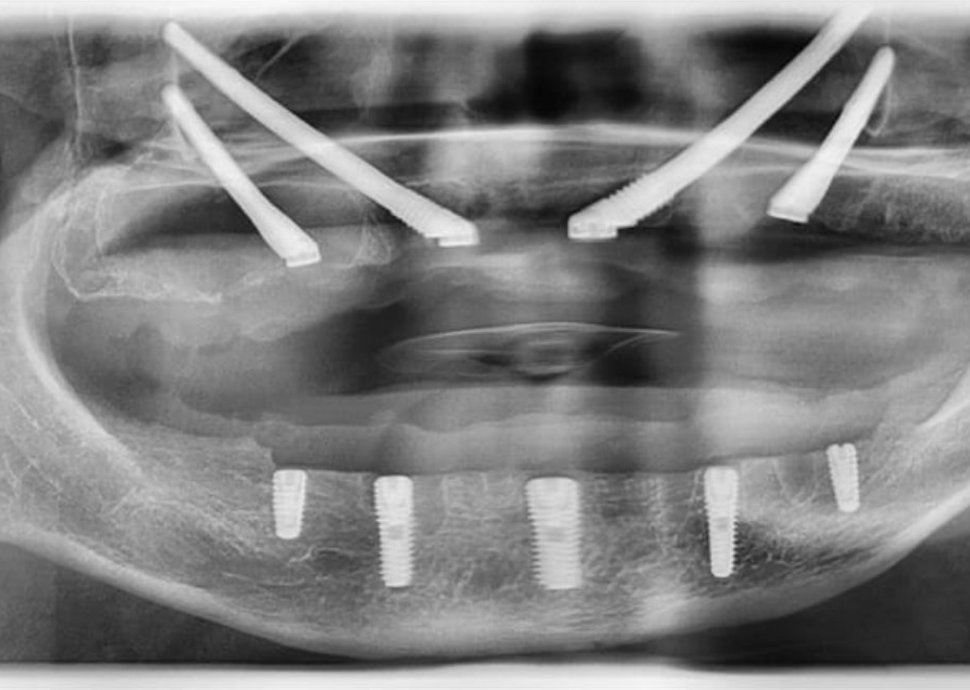 Zahnimplantate als gute Lösung.