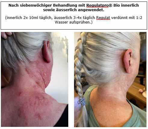 Herpes Zoster Herpes Zoster
