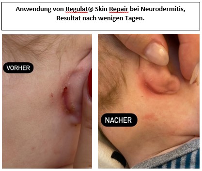 Neurodermitis Neurodermitis